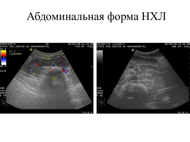 Абдоминальная форма НХЛ