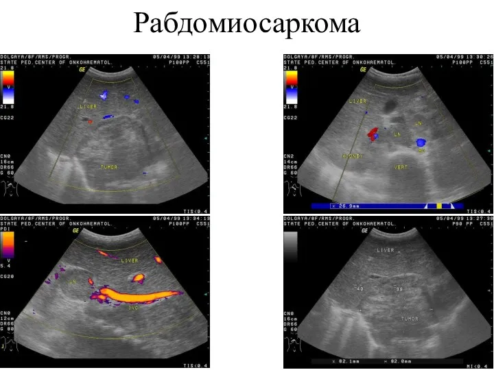 Рабдомиосаркома