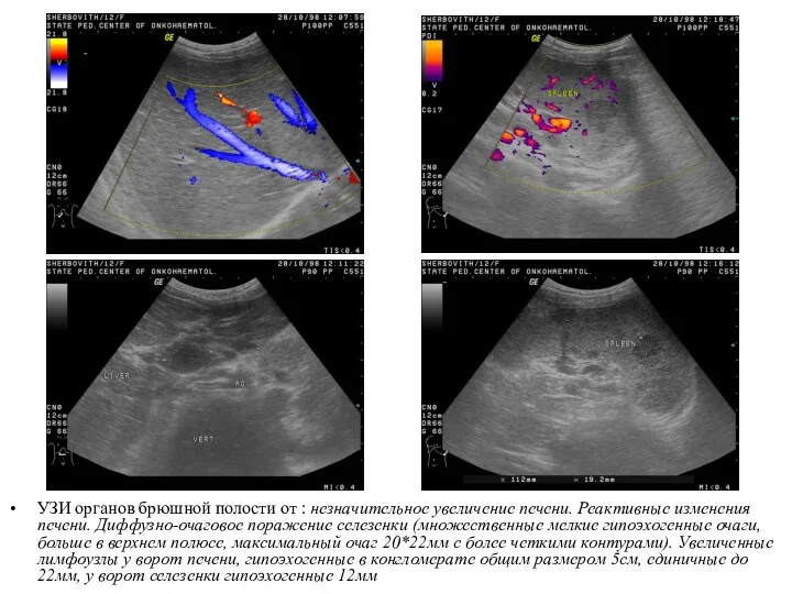 УЗИ органов брюшной полости от : незначительное увеличение печени. Реактивные