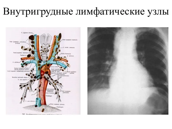 Внутригрудные лимфатические узлы