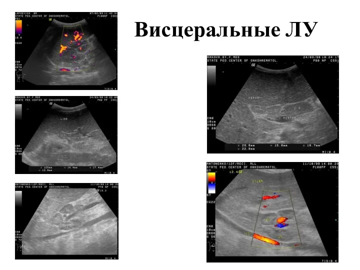 Висцеральные ЛУ