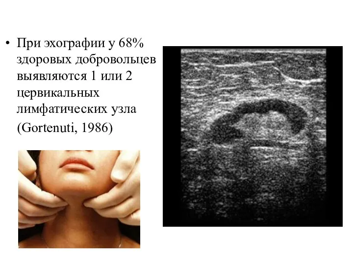 При эхографии у 68% здоровых добровольцев выявляются 1 или 2 цервикальных лимфатических узла (Gortenuti, 1986)