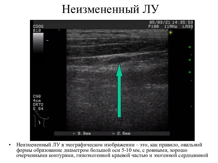 Неизмененный ЛУ Неизмененный ЛУ в эхографическом изображении – это, как