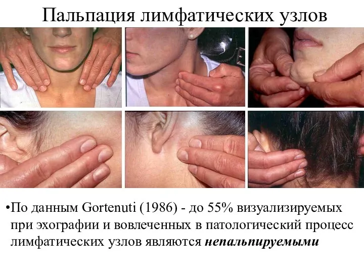 Пальпация лимфатических узлов По данным Gortenuti (1986) - до 55%