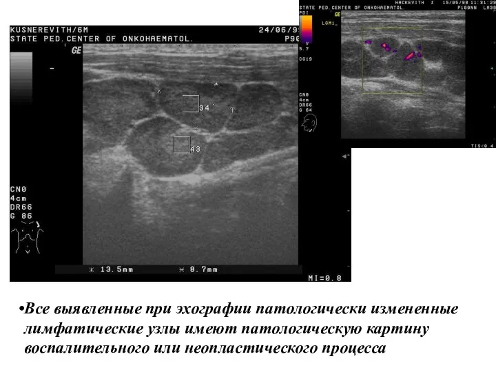 Все выявленные при эхографии патологически измененные лимфатические узлы имеют патологическую картину воспалительного или неопластического процесса