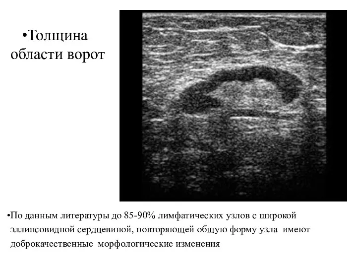 Толщина области ворот По данным литературы до 85-90% лимфатических узлов