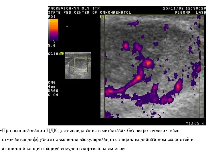При использовании ЦДК для исследования в метастазах без некротических масс
