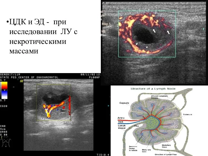 ЦДК и ЭД - при исследовании ЛУ с некротическими массами