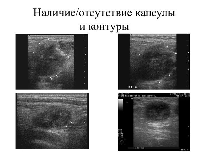 Наличие/отсутствие капсулы и контуры