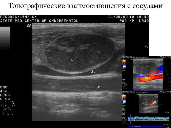 Топографические взаимоотношения с сосудами