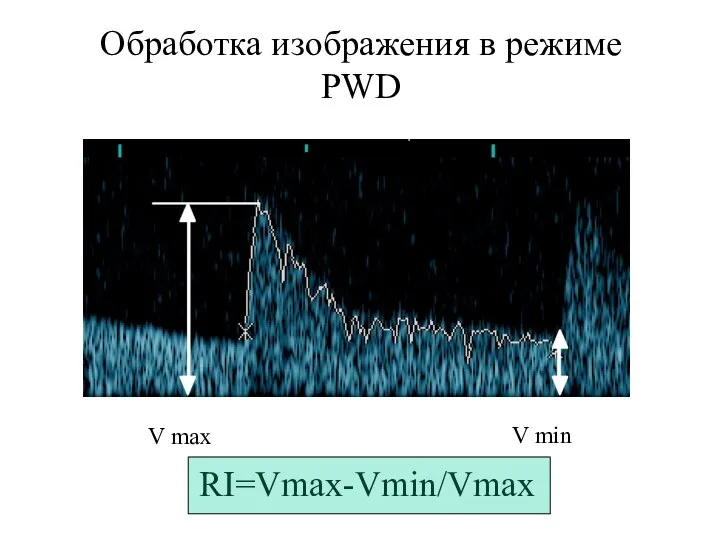 Обработка изображения в режиме PWD V max V min RI=Vmax-Vmin/Vmax