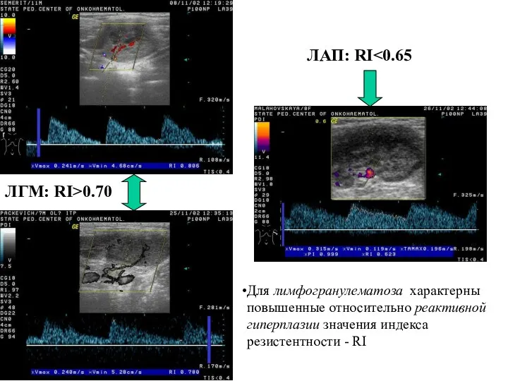 Для лимфогранулематоза характерны повышенные относительно реактивной гиперплазии значения индекса резистентности - RI ЛГМ: RI>0.70 ЛАП: RI
