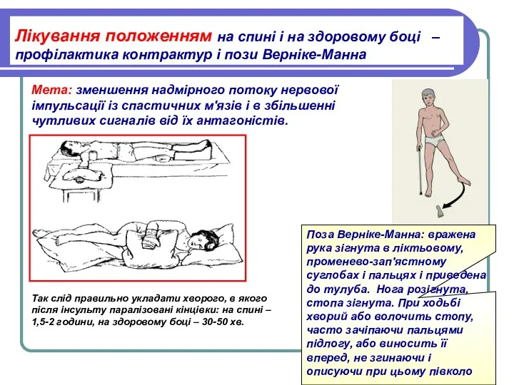 Так слід правильно укладати хворого, в якого після інсульту паралізовані