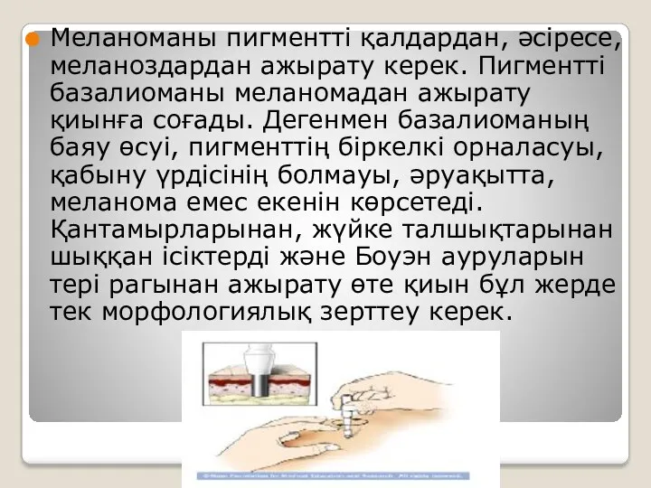 Меланоманы пигментті қалдардан, әсіресе, меланоздардан ажырату керек. Пигментті базалиоманы меланомадан