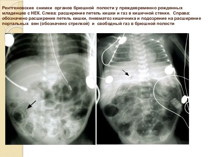 Рентгеновские снимки органов брюшной полости у преждевременно рожденных младенцев с НЕК. Слева: расширение