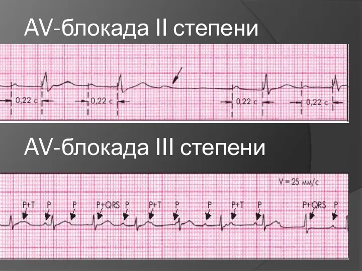 AV-блокада III степени AV-блокада II степени