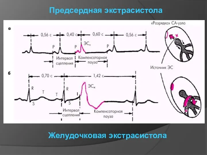 Предсердная экстрасистола Желудочковая экстрасистола