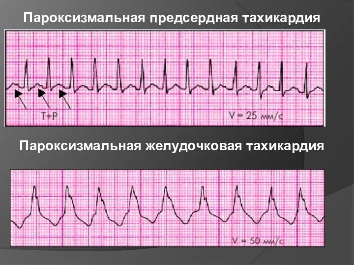 Пароксизмальная предсердная тахикардия Пароксизмальная желудочковая тахикардия