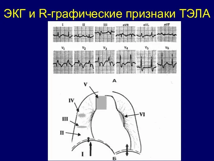 ЭКГ и R-графические признаки ТЭЛА