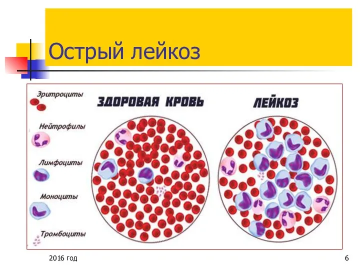 Острый лейкоз 2016 год