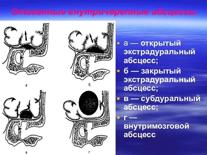 Отогенные внутричерепные абсцессы а — открытый экстрадуральный абсцесс; б —