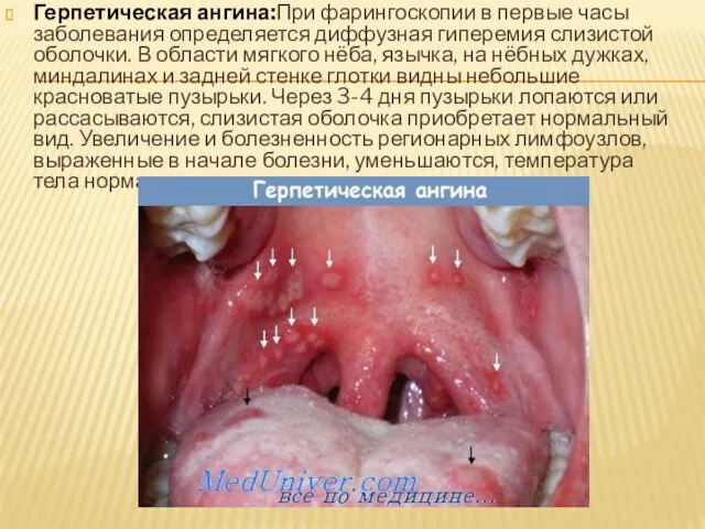 Герпетическая ангина:При фарингоскопии в первые часы заболевания определяется диффузная гиперемия