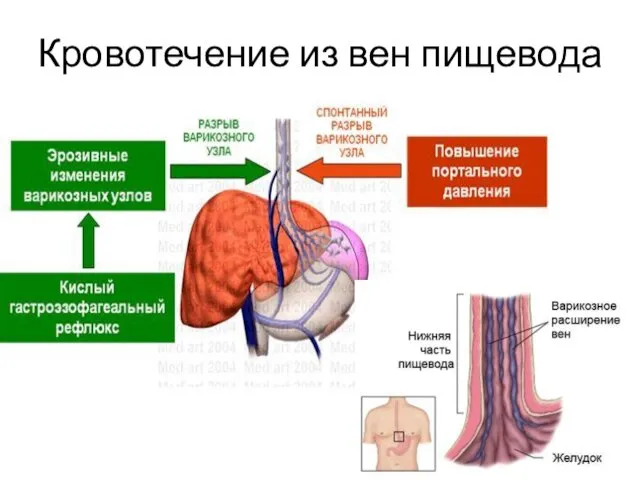 Кровотечение из вен пищевода