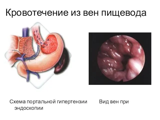 Кровотечение из вен пищевода Схема портальной гипертензии Вид вен при эндоскопии