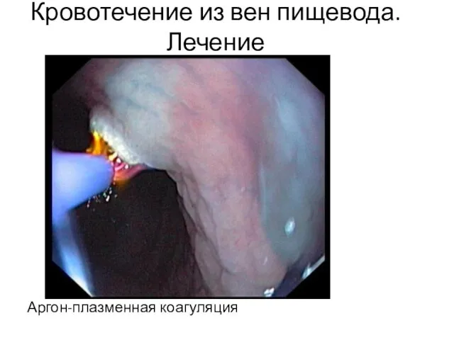 Кровотечение из вен пищевода. Лечение Аргон-плазменная коагуляция Аргон-плазменная коагуляция