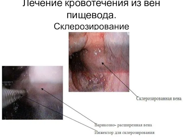 Лечение кровотечения из вен пищевода. Склерозирование