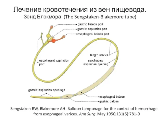 Лечение кровотечения из вен пищевода. Зонд Блэкмора (The Sengstaken-Blakemore tube)