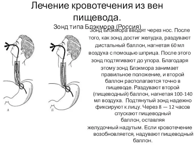 Лечение кровотечения из вен пищевода. Зонд типа Блэкмора (Россия) Зонд