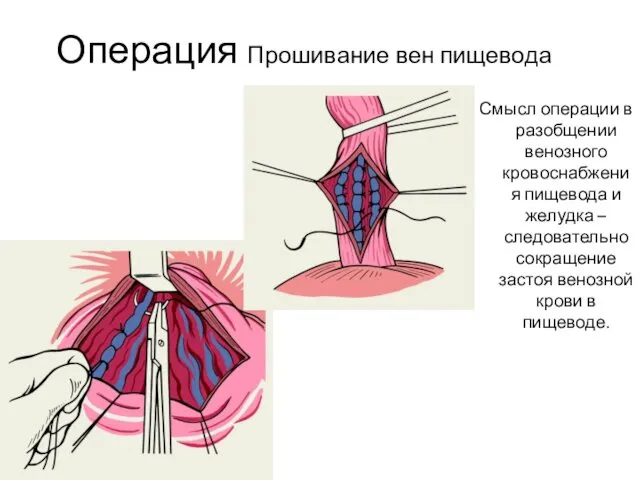 Операция Прошивание вен пищевода Смысл операции в разобщении венозного кровоснабжения