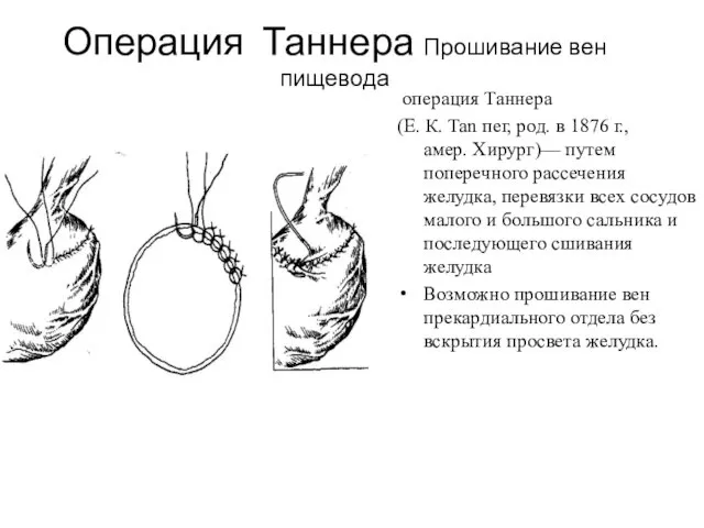 Операция Таннера Прошивание вен пищевода операция Таннера (Е. К. Tan