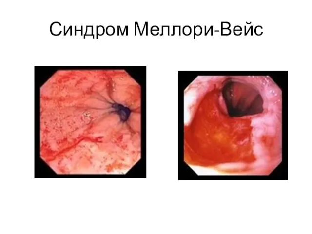 Синдром Меллори-Вейс