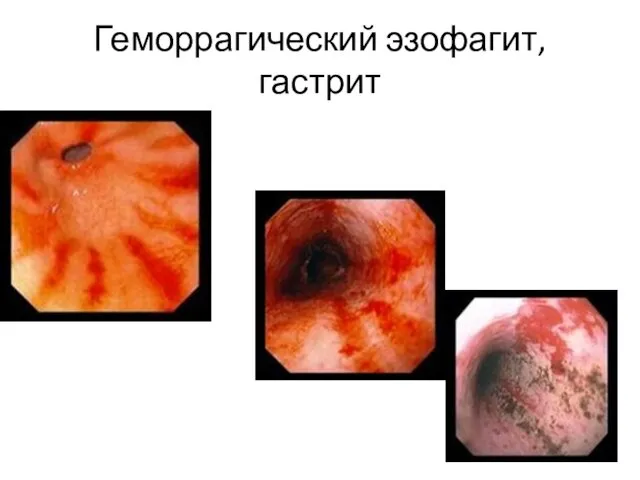 Геморрагический эзофагит, гастрит