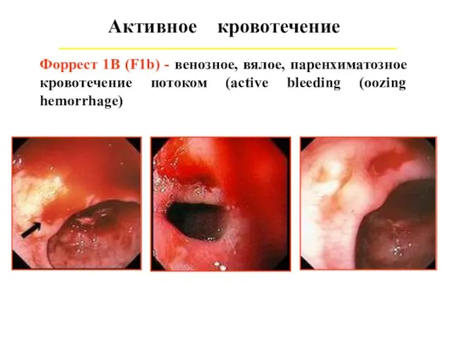 Активное кровотечение Форрест 1В (F1b) - венозное, вялое, паренхиматозное кровотечение потоком (active bleeding (oozing hemorrhage)