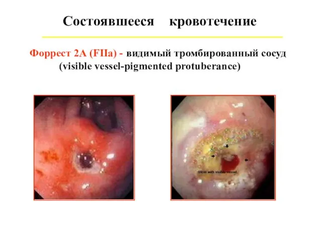 Состоявшееся кровотечение Форрест 2А (FIIa) - видимый тромбированный сосуд (visible vessel-pigmented protuberance)