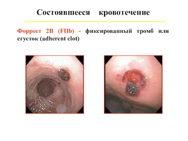 Состоявшееся кровотечение Форрест 2В (FIIb) - фиксированный тромб или сгусток (adherent clot)