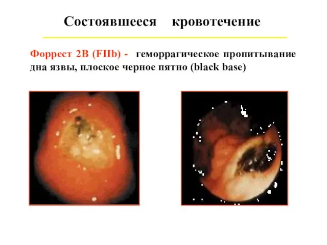 Состоявшееся кровотечение Форрест 2В (FIIb) - геморрагическое пропитывание дна язвы, плоское черное пятно (black base)