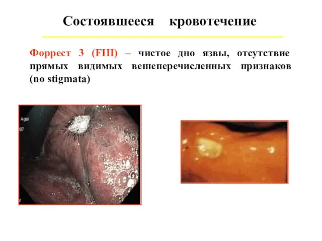 Состоявшееся кровотечение Форрест 3 (FIII) – чистое дно язвы, отсутствие прямых видимых вешеперечисленных признаков (no stigmata)