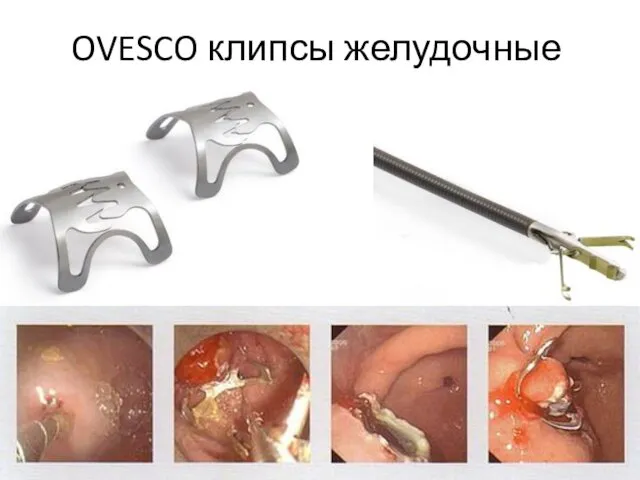 OVESCO клипсы желудочные