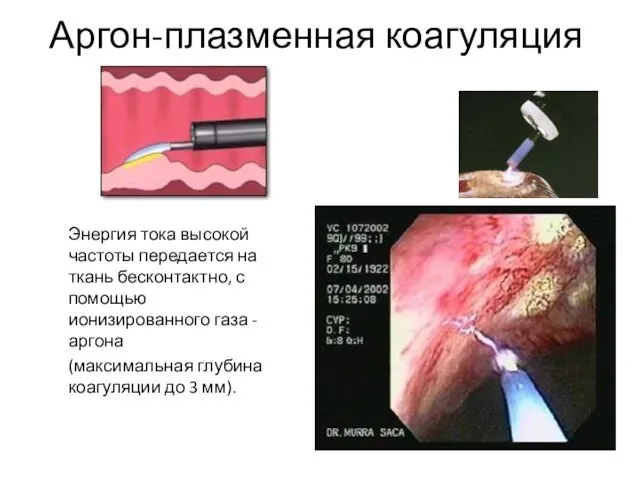 Аргон-плазменная коагуляция Энергия тока высокой частоты передается на ткань бесконтактно,