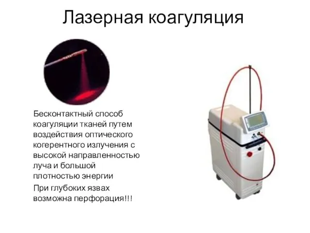 Лазерная коагуляция Бесконтактный способ коагуляции тканей путем воздействия оптического когерентного