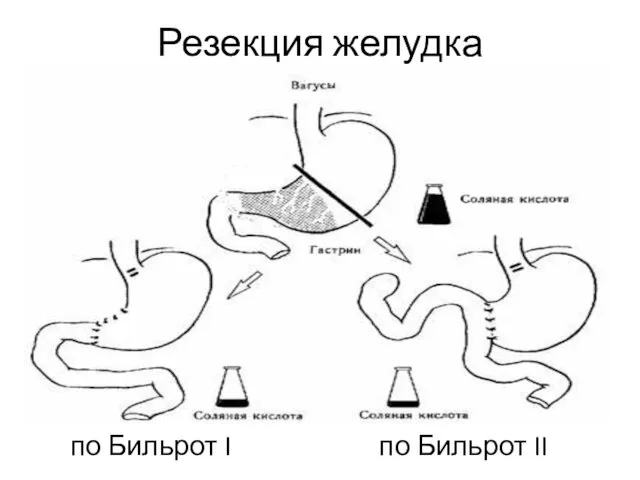 Резекция желудка по Бильрот I по Бильрот II