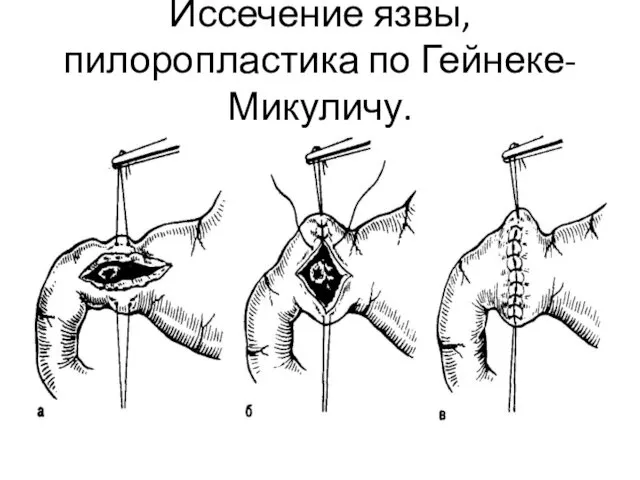 Иссечение язвы, пилоропластика по Гейнеке-Микуличу.