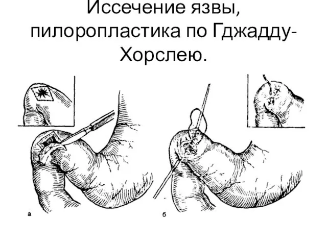 Иссечение язвы, пилоропластика по Гджадду-Хорслею.