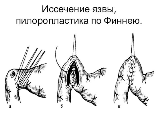 Иссечение язвы, пилоропластика по Финнею.