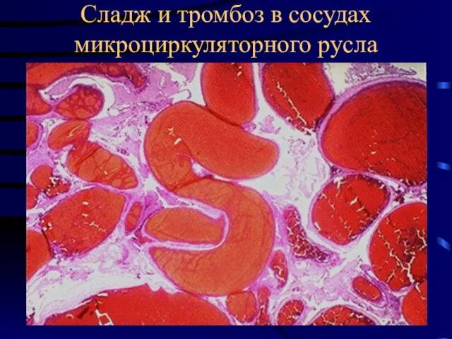 Сладж и тромбоз в сосудах микроциркуляторного русла