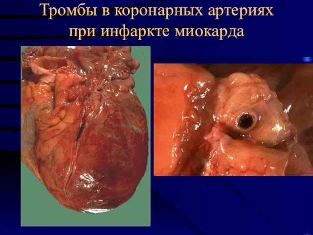 Тромбы в коронарных артериях при инфаркте миокарда